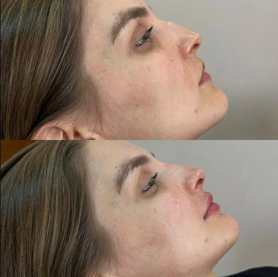 Harmonização facial
